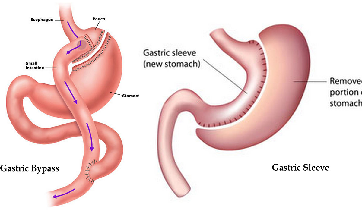 عملية تحويل مسار المعدة - الافضل فاعلية بين عمليات جراحات السمنة 12503 3