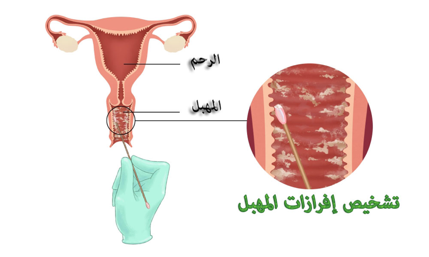 افرازات المهبل الطبيعية - مالا تعرفيه عن الافرزات المهبلية الطبيعية 11466