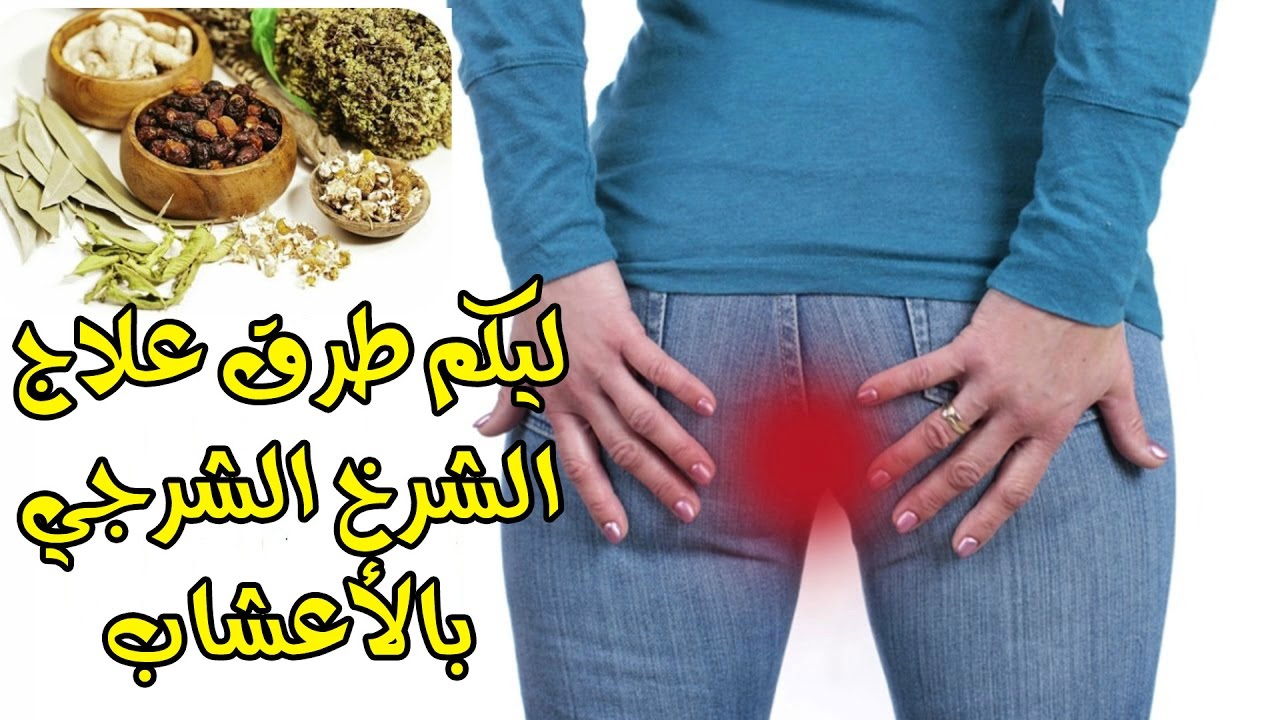 علاج البواسير - اعشاب تعالج البواسير بطريقه امنه 5203 1