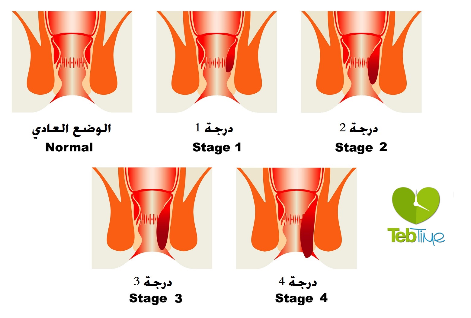 مرض البواسير - علاج البواسير 3237 1