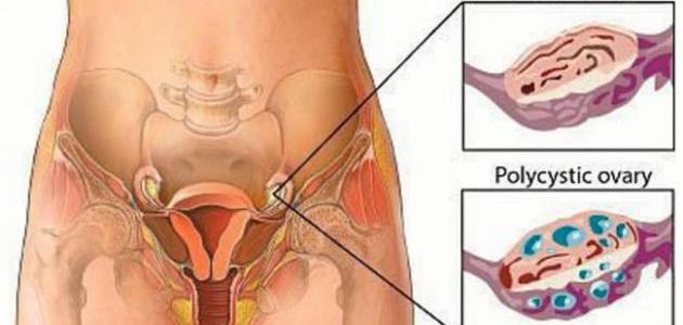 علاج التكيس - اسباب وعلاج التكيسات 4159 2