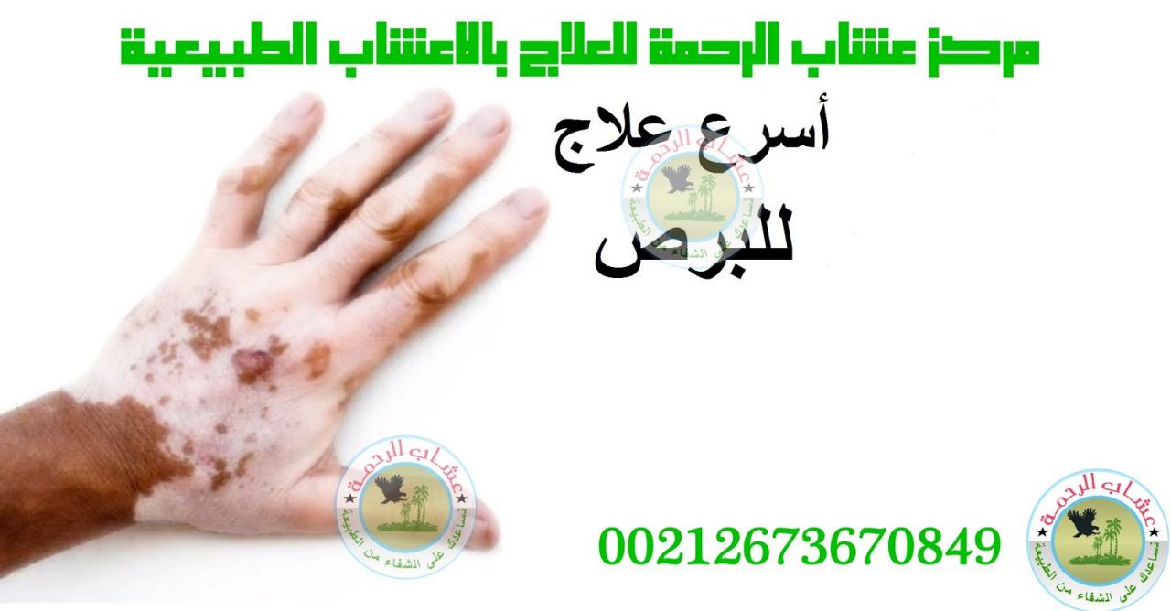 دواء البرص مجرب - طرق مجربه لعلاج البرص 11727 1