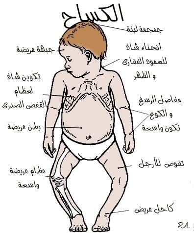 مرض الكساح - اعراض الكساح وما هو علاجه 4813 2