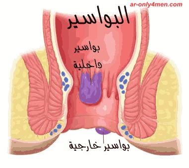 مرض البواسير , علاج البواسير