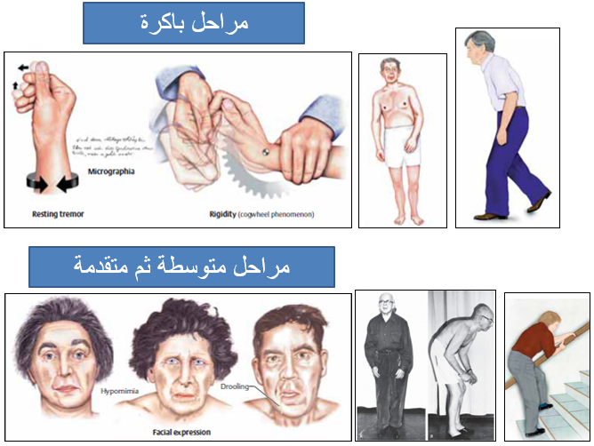 مرض باركنسون - اقوى المعلومات عن مرض باركنسون 5374