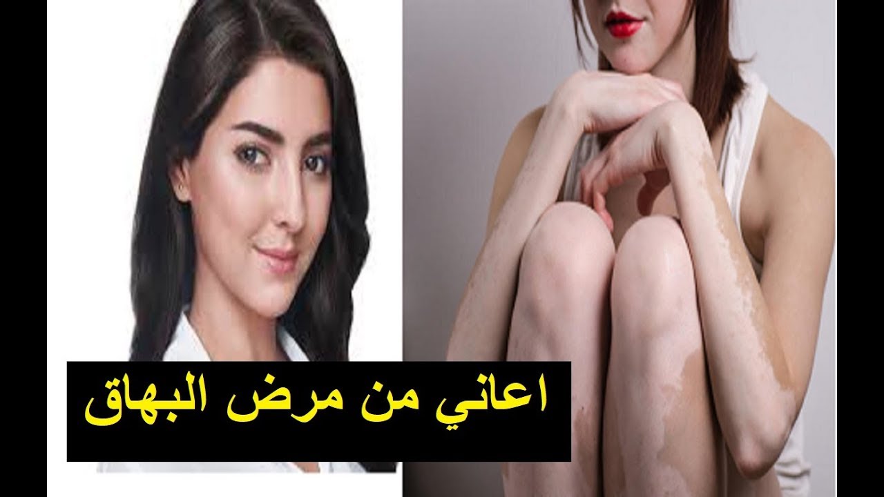 علاج البهاق بالاعشاب - كيفيه التخلص من البهاق نهائيا 6670 2