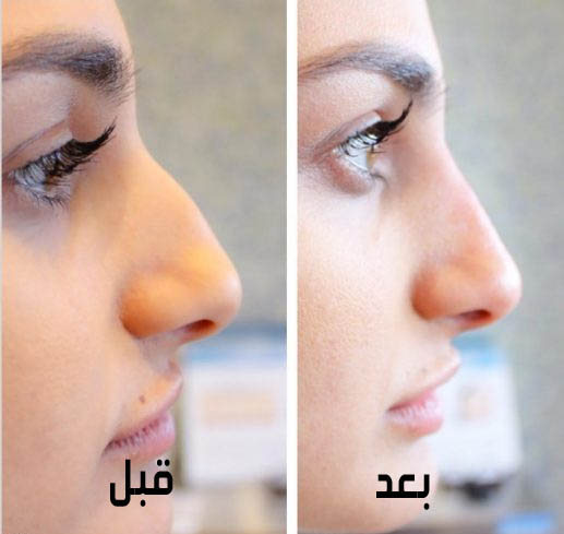 كم تكلفة عملية تجميل الانف في سليمان الحبيب - اسعار تجميل الانف 12570 2