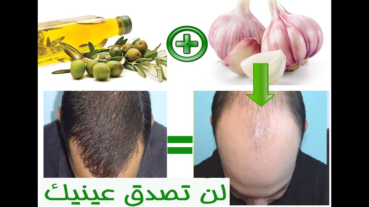 علاج تساقط الشعر بالثوم وزيت الزيتون - اقوى الوصفات التى تساعد علي تقوية الشعر 11866 3