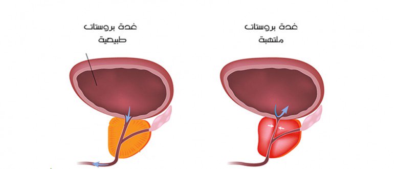 مرض البروستات , كيفيه نشاءة مرض البروستاتة