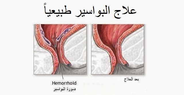 علاج البواسير , اعشاب تعالج البواسير بطريقه امنه