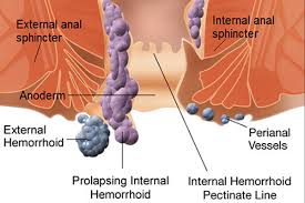 اسباب البواسير , اعراض مرض البواسير