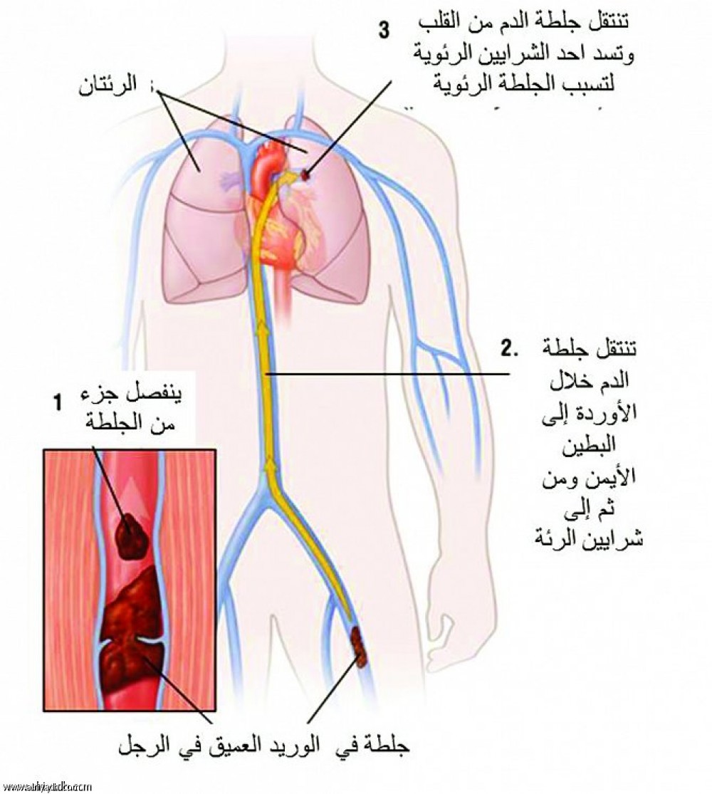 اعراض جلطة الرئة , ماهي الاعراض الخاصة بجلطة الرئه