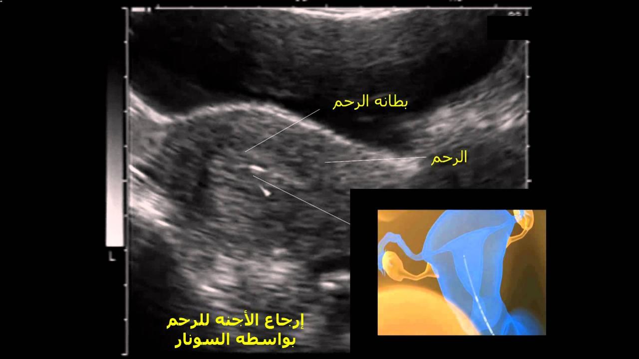 علامات ثبوت الاجنه بعد الترجيع , كيف نغرف ثبوت الاجنه بعد الترجيع