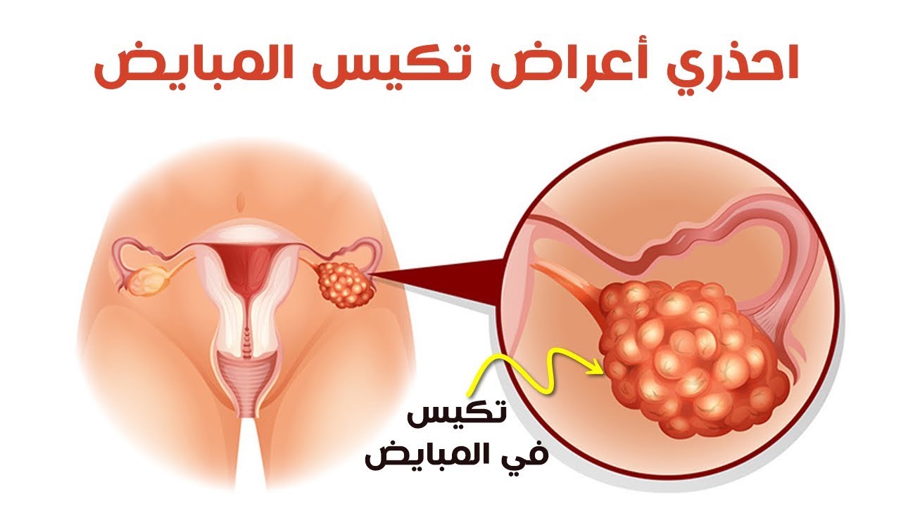 ماهي اعراض تكيس المبايض