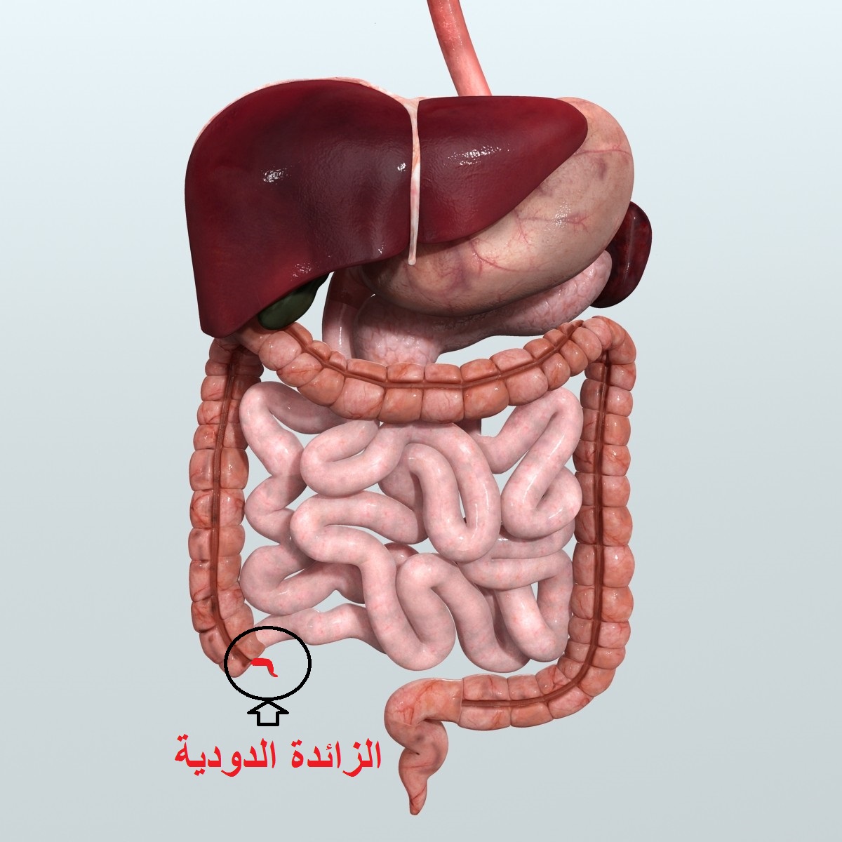 التهاب شديد جدا , اعراض الزائدة الدودية