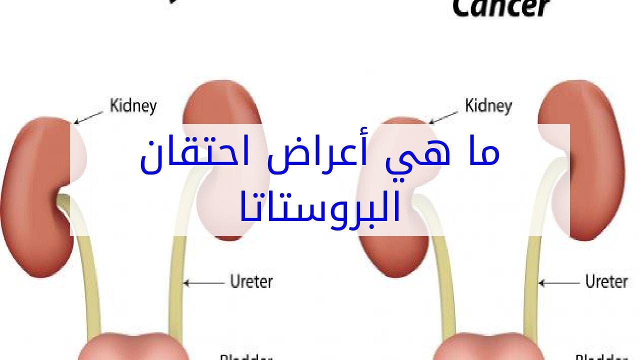 اعراض البروستاتا - كيفية التعرف علي مرض البروستاتا 5584 1