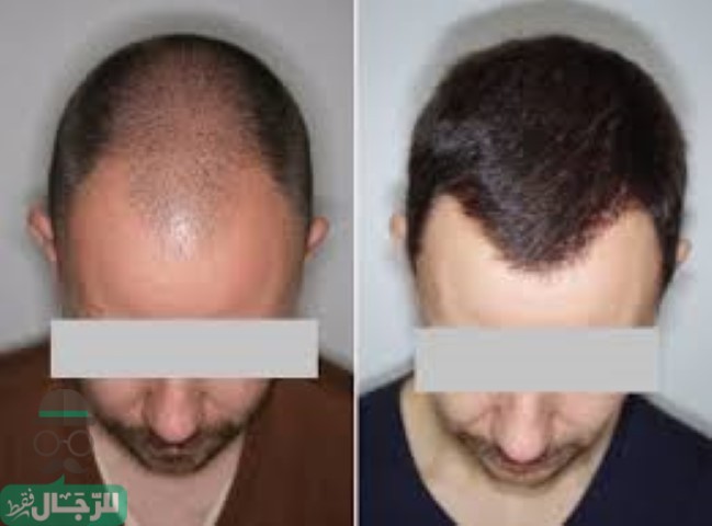 زراعة الشعر بالكويت - اهمية زراعة الشعر 11506 1