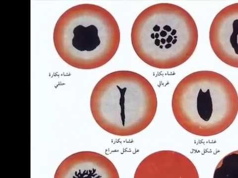 ترقيع البكاره في المنزل , طرق ترقيع البكارة