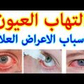 0 21 علاج العين - كيفية علاج التهابات العين رفيعة ديالى