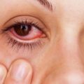 6046 1 علاج حساسية العين رفيعة ديالى