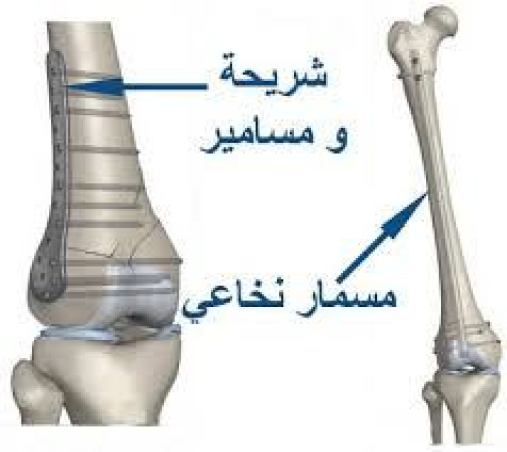 عملية المسمار النخاعي , اصعب العمليات الموجوده